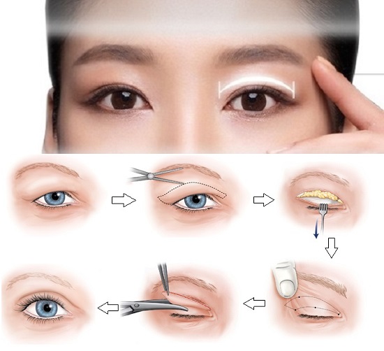 Quy trình cắt mí mắt tại Siam